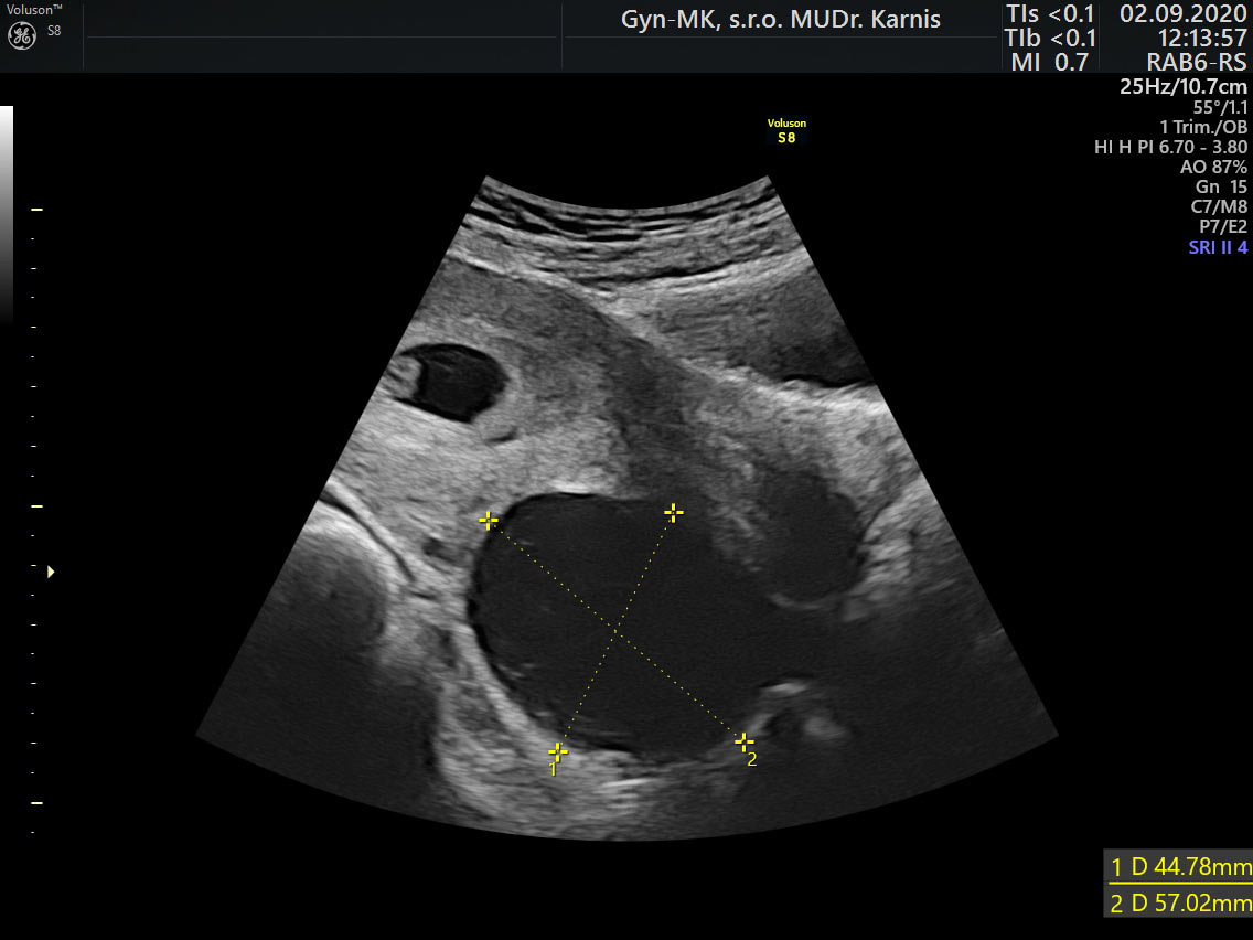 Anechogénna cysta ovária v tehotenstve uložená retrouterinne